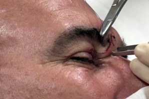 Joel Parkinson durante a sutura