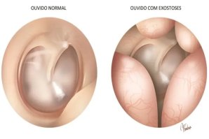 As Exostoses ou Ouvido de Surfista explicadas em detalhe